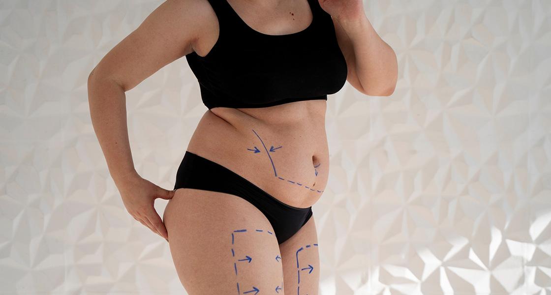 Liposuction / Liposculpture