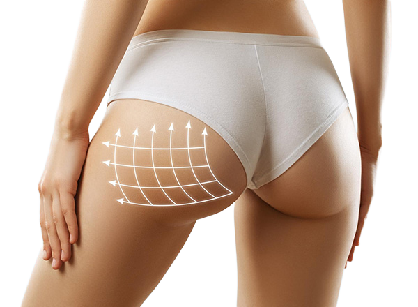 BBL – Brazilian Butt Lift