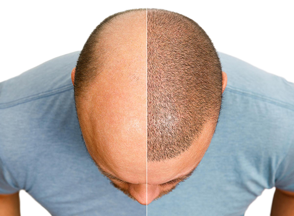 FUE Hair Transplant