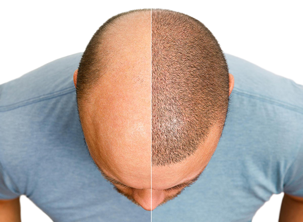 FUE Hair Transplant