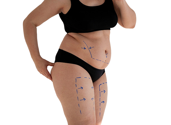 Liposuction / Liposculpture