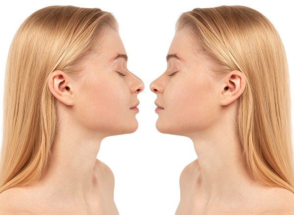 Primary Rhinoplasty